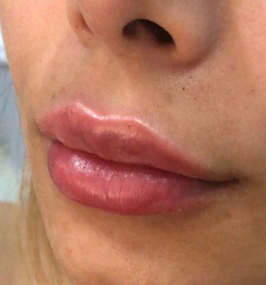Read more about the article PREENCHIMENTO LABIAL