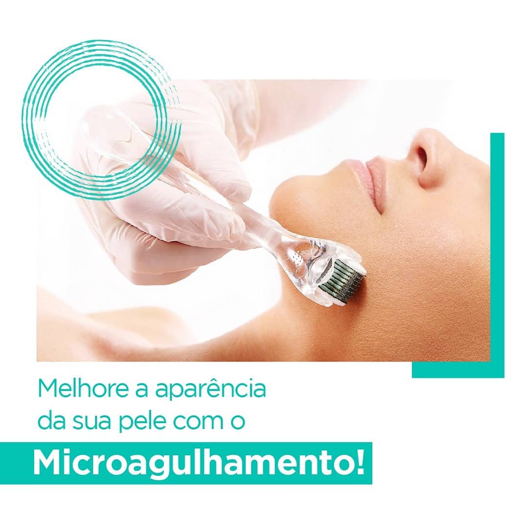 Read more about the article MICROAGULHAMENTO